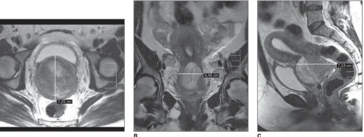 Figure 4. A: Axial T2-weighted TSE sequence, the same patient in Figure 3 in an uppermost plane