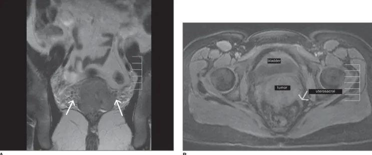 Figure 6. A: Coronal T2-weighted TSE sequence showing bilateral parametrial invasion, loss of hypointense halo separating the interface between the cervical stroma and the parametrial fat