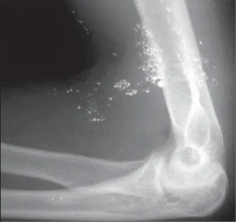 Figure 1. Left forearm lateral radiograph showing several spherical metallic densities clustered in soft tissues of distal portions of the arm and in the  ul-nar fossa.
