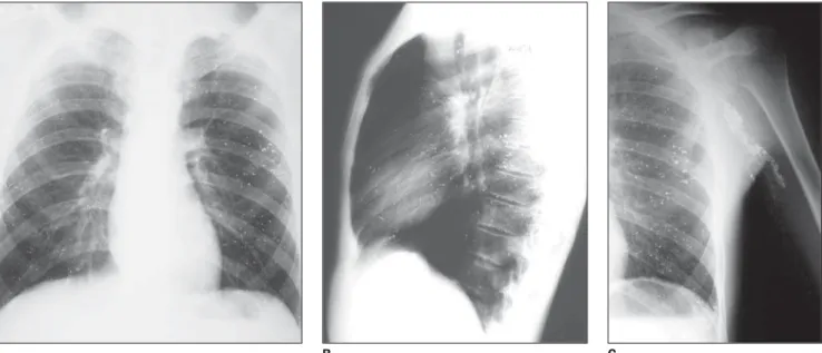 Figure 2. Posteroanterior (A) and lateral (B) chest radiographs showing several, bilateral, sparse spherical metallic densities throughout the pulmonary paren- paren-chyma and in the mediastinal shadow