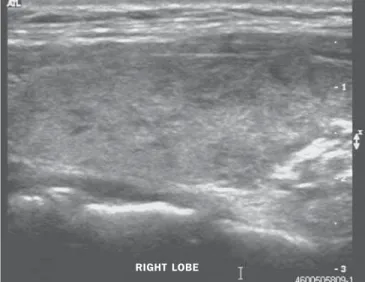 Figure 3. Heterogeneous thyroid gland with poorly defined hypoechogenic areas, and slightly lobular margins.