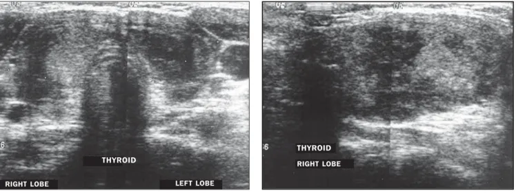 Figure 4. De Quervain’s thyroiditis. Hypoechogenic areas with poorly defined and irregular contours are observed, especially in subcapsular areas.