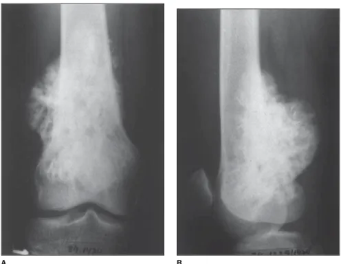 Figure 3. Anteroposterior (A) and lateral (B) x-rays of distal femur showing radiodense sessile mass on the bone cortical surface, localized in the popliteal fossa, and tending to wrap around the host bone.