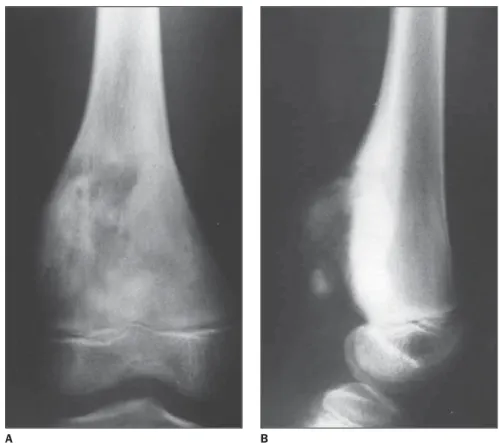 Figure 5. Anteroposterior (A) and lateral (B) x-rays of middle third and distal femur