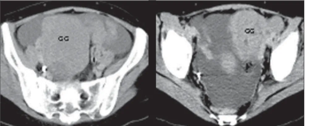 Figure 4. Parietal thickening of small intestinal loop (arrow); note lymphadenopathy (GG) at right (NHL, Burkitt subtype).