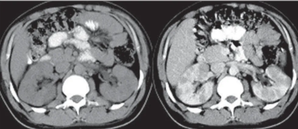 Figure 8. Bilateral, solid renal nodules - pre-contrast at left, and post-contrast at right