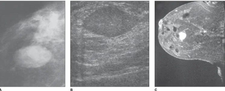 Figure 1. Examples of nodules classified as BI-RADS category 3. A: Mammographic image of an isodense, well-circumscribed ovoid nodule