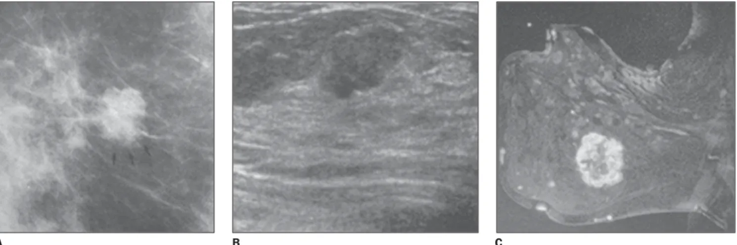 Figure 2. Examples of nodules classified as BI-RADS category 4. A: Mammographic image showing an isodense, irregular nodule with microlobulated margins.