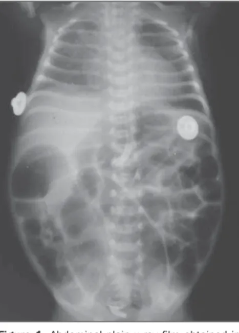 Figure 1. Abdominal plain x-ray film obtained in dorsal decubitus demonstrating generalized  intes-tinal distension.