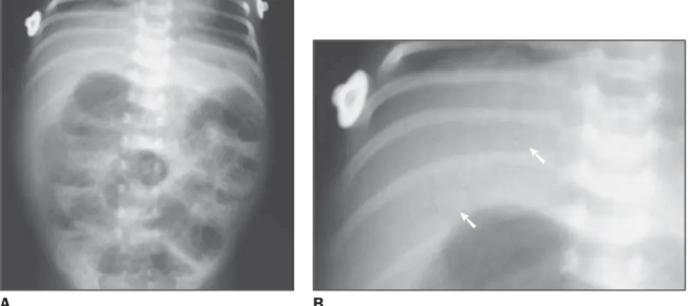 Figure 5. Abdominal plain x-ray in dorsal decubi- decubi-tus showing abdominal hypertransparency because of pneumoperitoneum