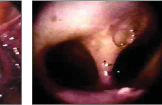 Figure 7. Normal uterus on 3D multiplanar ultrasound. Observe the secretory pattern of the endometrium on the three views.
