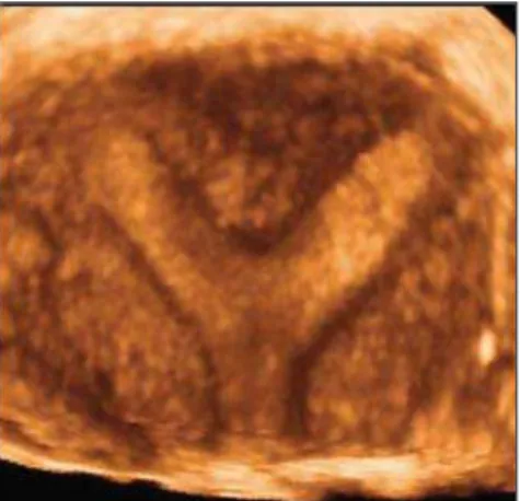 Figure 9. Coronal view of a septate uterus on 3D volumetric ultrasound with digital subtraction of the endometrium.