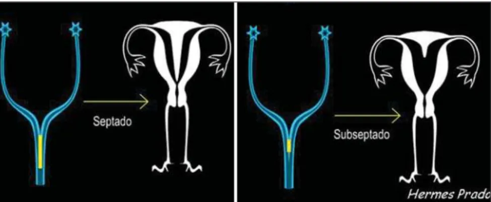 Figure 16. Schemes showing failures in complete (didelphys uterus) and partial  (bi-cornuate uterus)  fu-sion of the Müllerian ducts.