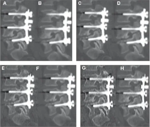 Figure 5. Sagittal oblique reconstructions. A: Filter 20 with 2mm de slice thickness; B: filter 20 with 4mm de slice thickness; C: filter 40 with 2mm de slice thickness; D: filter 40 with 4mm de slice thickness; E: filter 60 with 2mm de slice thickness; F: