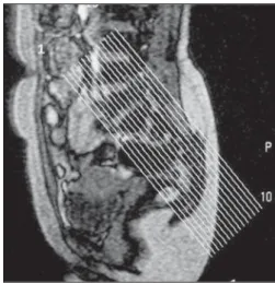 Figure 2. Survey on sagittal plane showing the schedule for MRI  coro-nal oblique plane views.