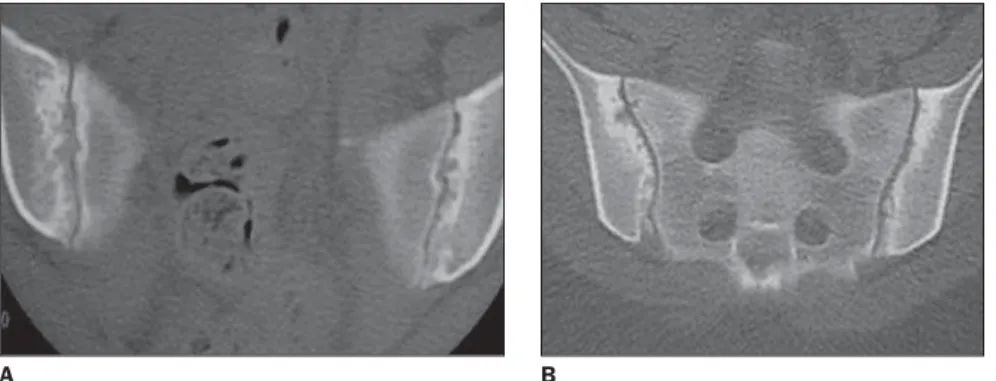 Figure 4. Radiographic classifica- classifica-tion in the evaluaclassifica-tion of sacroiliac joints