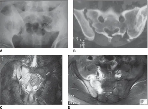Figure 16. Elder patient with back pain. MRI coronal oblique views, T1 (A) and T1-weighted, fat-saturated sequences (B) showing diffuse bone marrow reconversion (hypersignal on T1), with signal loss in the  fat-saturated sequence.