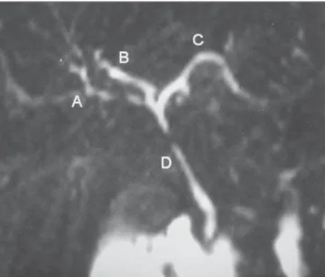 Figure 3. MR cholangiography demonstrating right posterior hepatic duct tribu- tribu-tary to the left hepatic duct