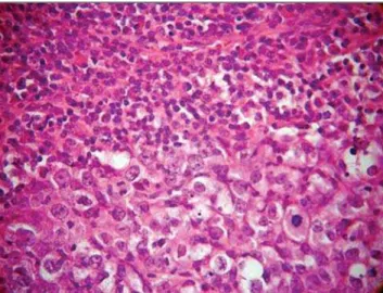 Figure 1. A well-defined lesion constituted by a sheet-shaped layer of tumor cells separated by a small amount of connective tissue