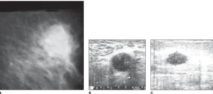 Figure 3. Mammography demonstrating an irregular mass with obscured margins (A). BI-RADS category IV