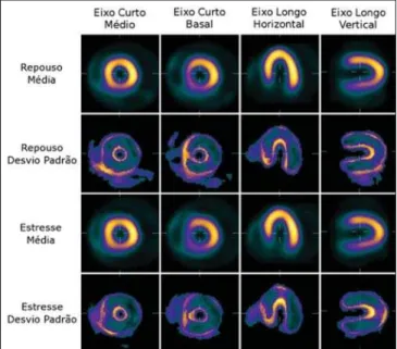 Figure 3. Tomographic sections of SPECT of myocardial perfusion  im-ages illustrating the patient’s images before and after alignment with the target images.