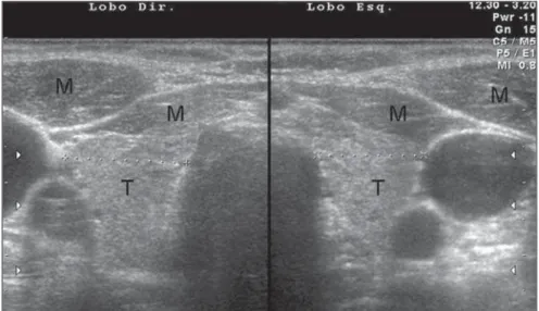 Figure 1. Transversal view of left and right thyroid lobes. B-mode US demonstrates typical aspect of thyroid parenchyma echogenicity