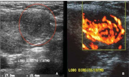Figure 3. Focal chronic autoimmune thyroiditis represented by a hypoechoic, partially defined nodule (A) demonstrating hypervascularization at amplitude color Doppler (B).