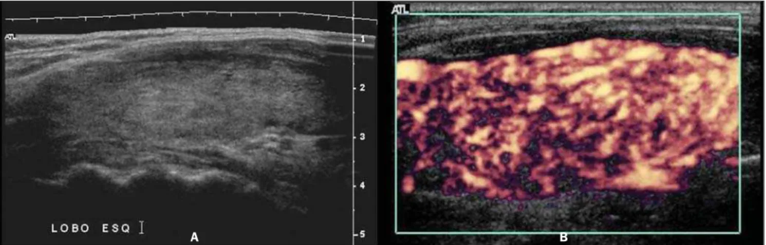 Figure 4. Longitudinal views of thyroid lobe. Mode-B US demonstrates a diffusely heterogeneous texture of the thyroid parenchyma with no nodule (A)