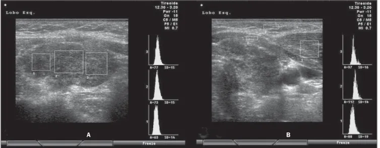 Figure 9. At left, computed histogram in a longitudinal view of the thyroid parenchyma, and at left, in a transverse view of the sternocleidomastoid muscle (1), prethyroid musculature (2) and subcutaneous fat tissue (3)
