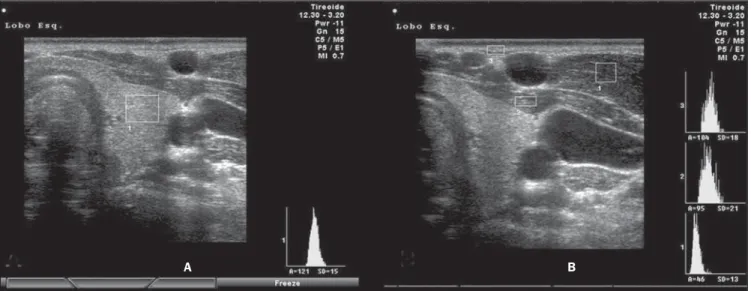 Figure 12. Computed histogram in a transverse view of the thyroid gland e sternocleidomastoid of an individual with normal echogenicity (A) and of another with chronic autoimmune thyroiditis (B)