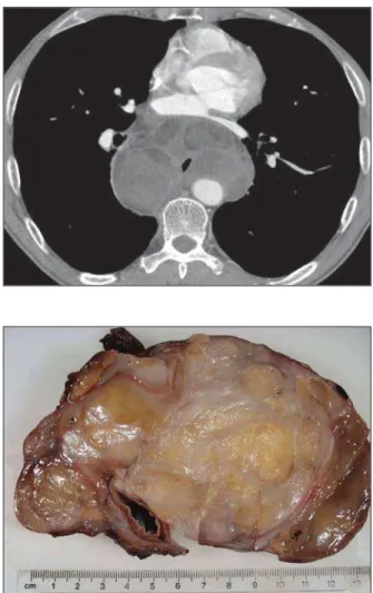 Figure 2. Contrast enhanced axial CT scan showing a large lobulated mass with multiple areas showing fat density  be-hind the left atrium