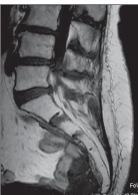 Figure 1. Computed tomography – axial view. Figure 2. Magnetic resonance imaging – sagit- sagit-tal, T1-weighted image.