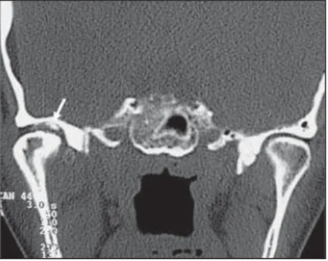 Figure 8. Osteonecrosis. Sagittal MRI T2-weighted image: note the marked irregularity of the condyle contour (arrowhead), with heterogeneous signal, and medullary sclerosis in the remaining condyle characterized by the signal hypointensity (arrow).