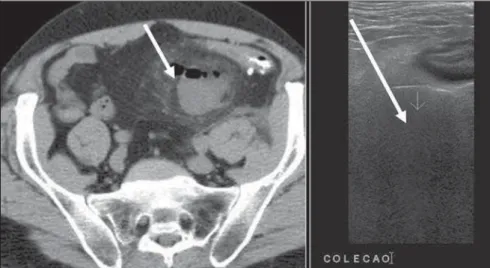 Figure 3. Extraluminal abscess with air-fluid level adjacent to the sigmoid colon at left