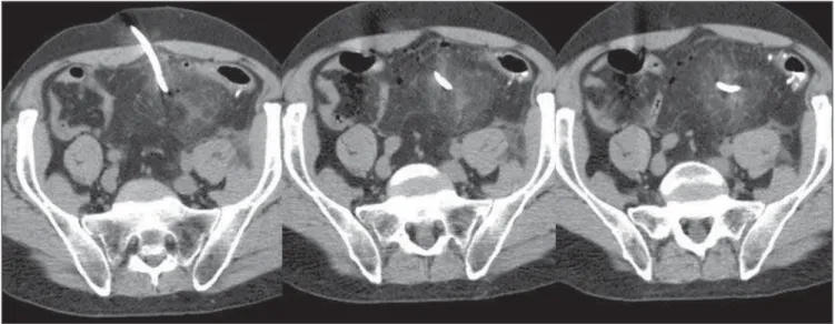 Figure 4. Tomographic follow-up after drainage demonstrating a complete drainage of the collection with a drain placed inside the abscess cavity.