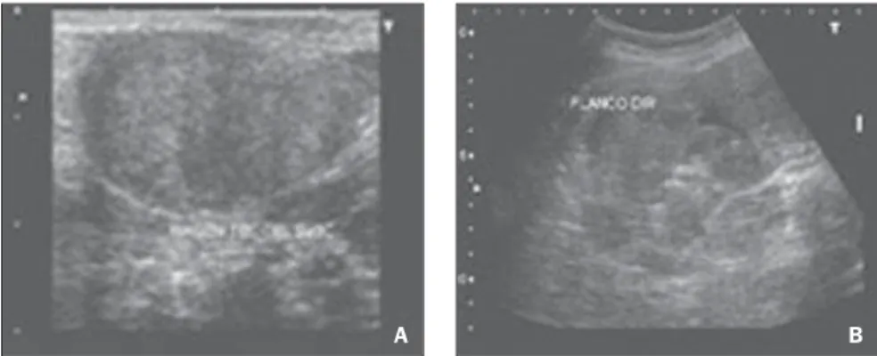Figure 2. Computed tomography demonstrates several, small nodules with soft tissue densities (A), with homogeneous venous contrast uptake (B), from the pelvis to the upper abdomen.
