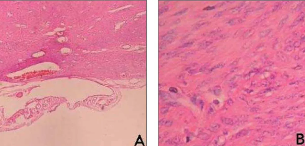 Figure 4. Biopsy plate (A). Myocyte bundle presenting ovoid nuclei and bipolar, long and thin cytoplasmatic prolongations (B).