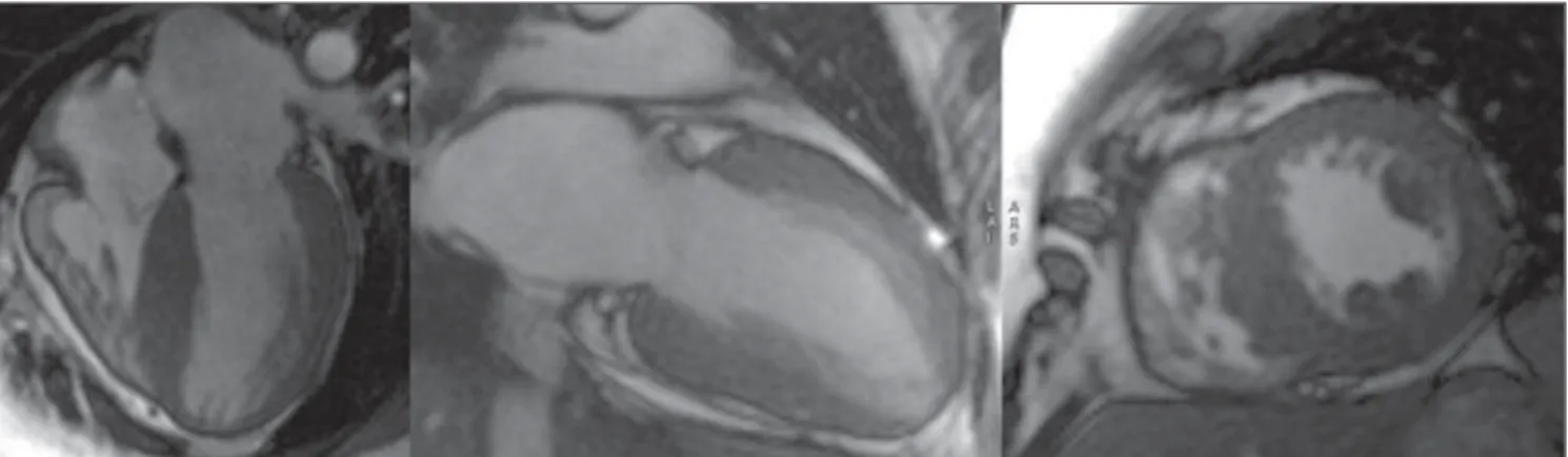 Figura 2. Aquisições acopladas ao ECG, realce tardio nos planos em eixo curto, medial e basal, com diferentes tempos de inversão.