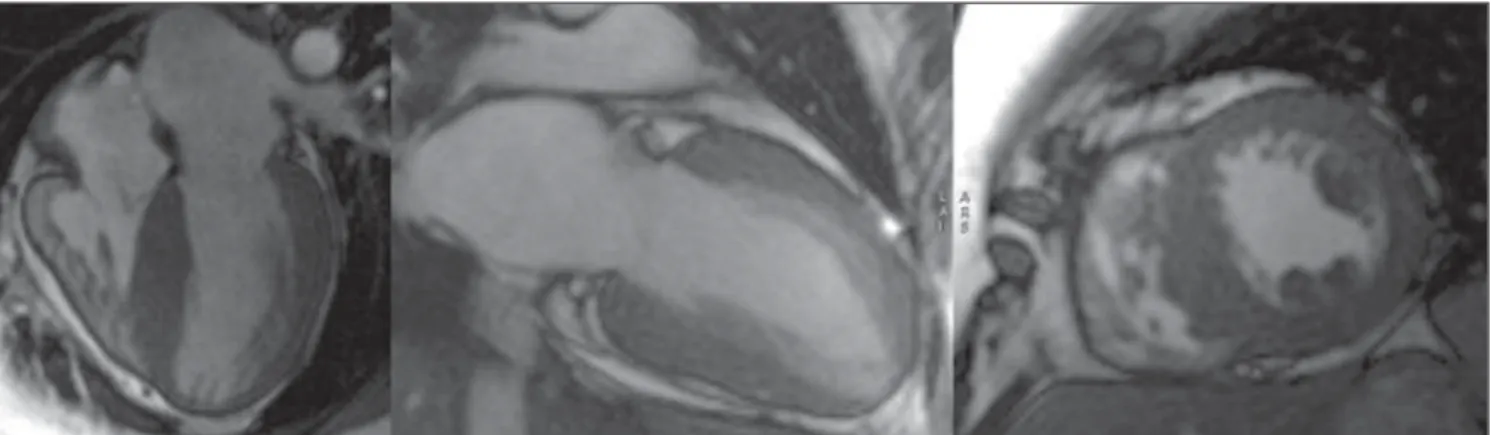 Figure 2. Images acquisition with ECG-gating, delayed enhancement, medial and basal short-axis views, with different inversion times.
