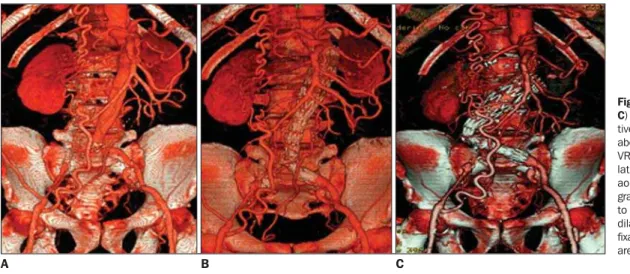Figure 1. VRT images (A,B, C) show pre- and  postopera-tive evolupostopera-tive follow-up of abdominal aortic aneurysm.