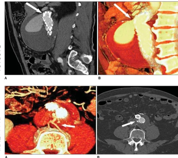 Figure 2. Signs of type I endoleak in the postero- postero-lateral border of the proximal fixation ring (arrow).