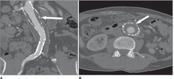 Figure 5. Circumferential thrombus in an endograft.