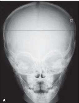 Figure 1. A: Frontal view – radiographic measurement of the biparietal diameter.