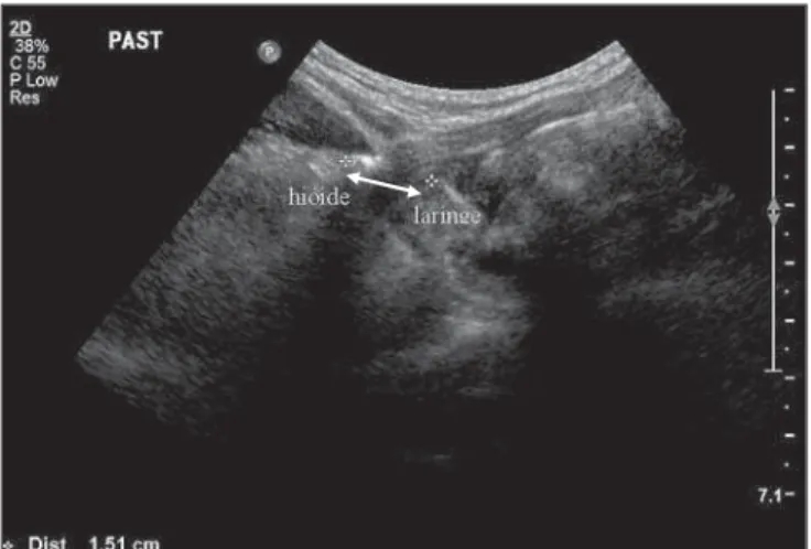 Figure 4. Distance in centimeters of the  hyoid-larynx segment during deglutition of pasty food (yogurt).