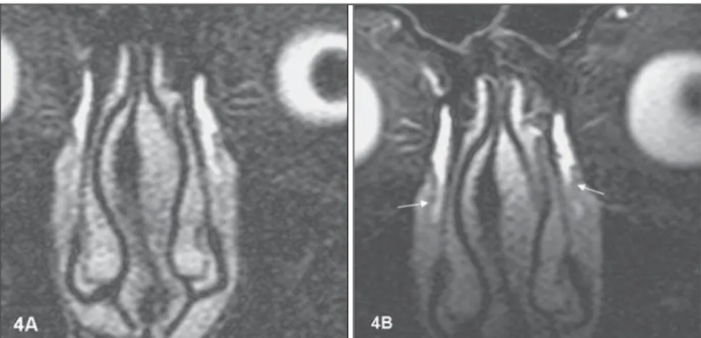 Figure 3. Case 2. In this case, lacrimal ducts were hardly identified on images acquired with conven- conven-tional surface coil (3A)