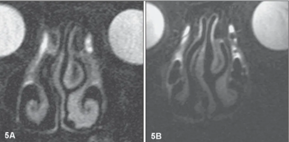 Figure 6. Additionally to the better signal-to-noise ratio, the study with microscopic coil (6B), has al- al-lowed a better characterization of lacrimal ducts at right (arrows).