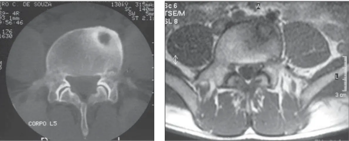 Figure 3. MRI, axial, T2-weighted image. Figure 4. Post-resection, axial CT image of the lesion.