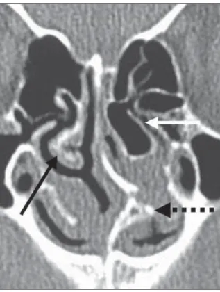 Figure 1. Normal anatomy of the anterior ostiomeatal complex. Frontal sinus (SF);