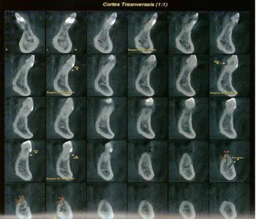 Figura 1. Análise de tomografia de mandíbula atrófica vista frontal. 