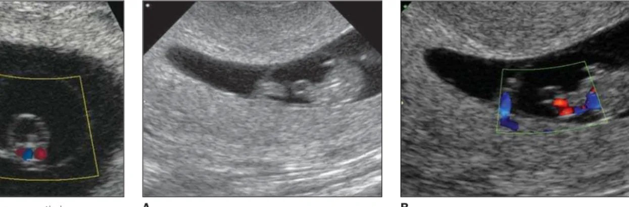 Figure 3. Case 1. A: Cystic image at the first gestational trimester, within the amniotic membrane